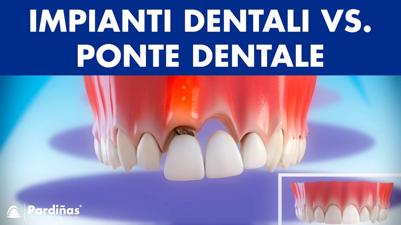 Impianti dentali vs. Ponte dentale – Confronto ©