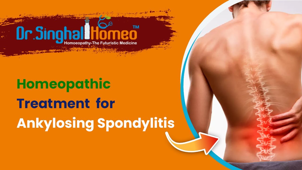 होम्योपैथी में एंकिलोजिंग स्पोंडिलिटिस का उपचार | Homeopathic Medicine for Ankylosing Spondylitis