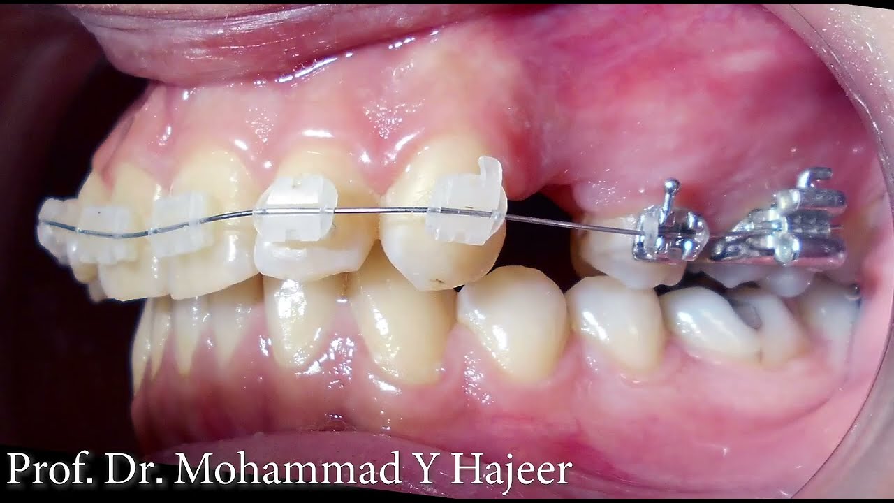 علاج حالات البروز في أسنان الفك العلوي بقلع ضواحك علوية فقط- - الدكتور محمد يونس حجير