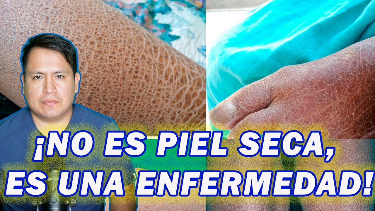 Ictiosis vulgar: la causa secreta detrás de tu piel seca y áspera