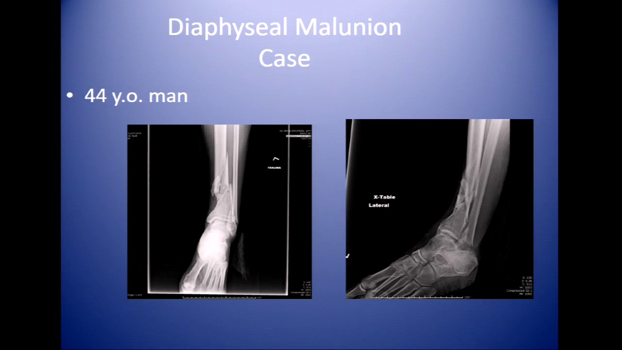 Post traumatic deformity and nonunion - Panel discussion
