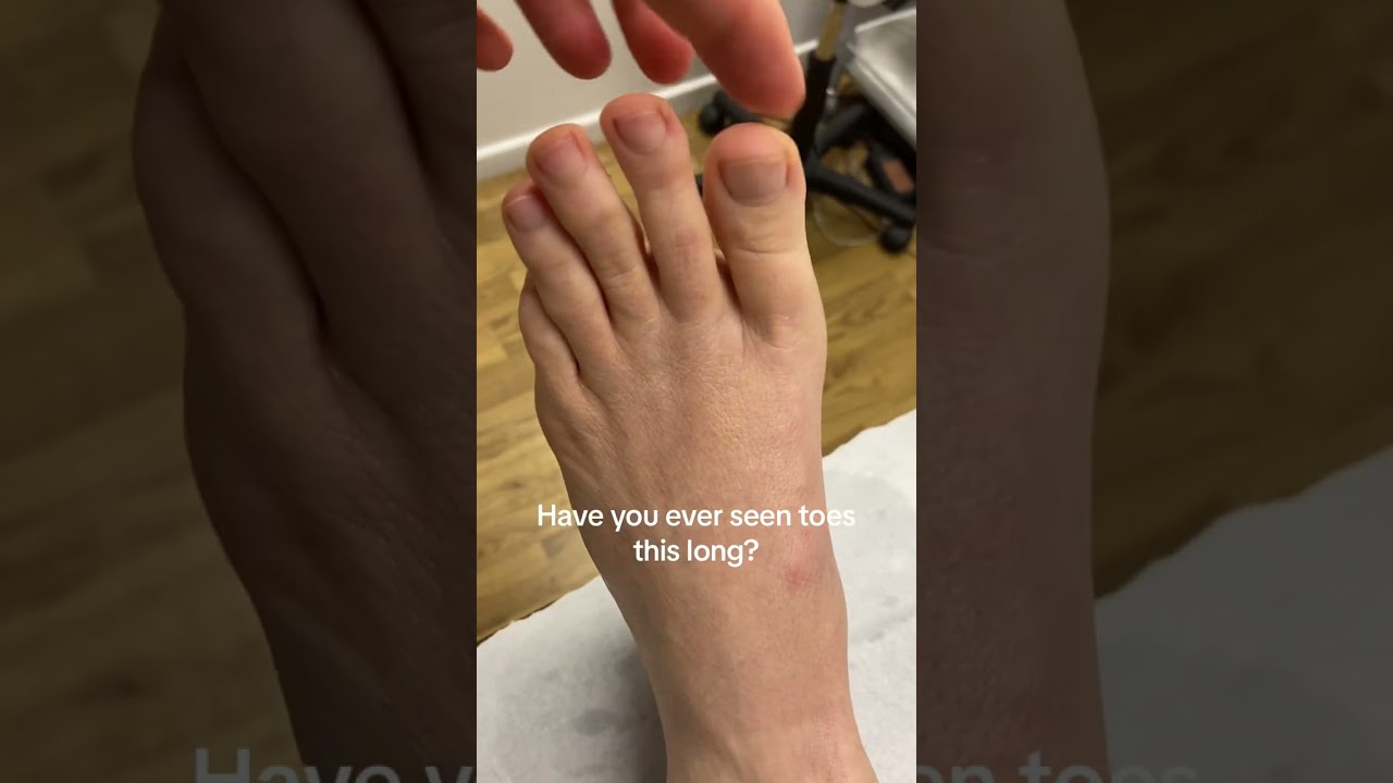 Unbelievably Long Toes: A Fascinating Foot Phenomenon #IncredibleFeet #MustSee