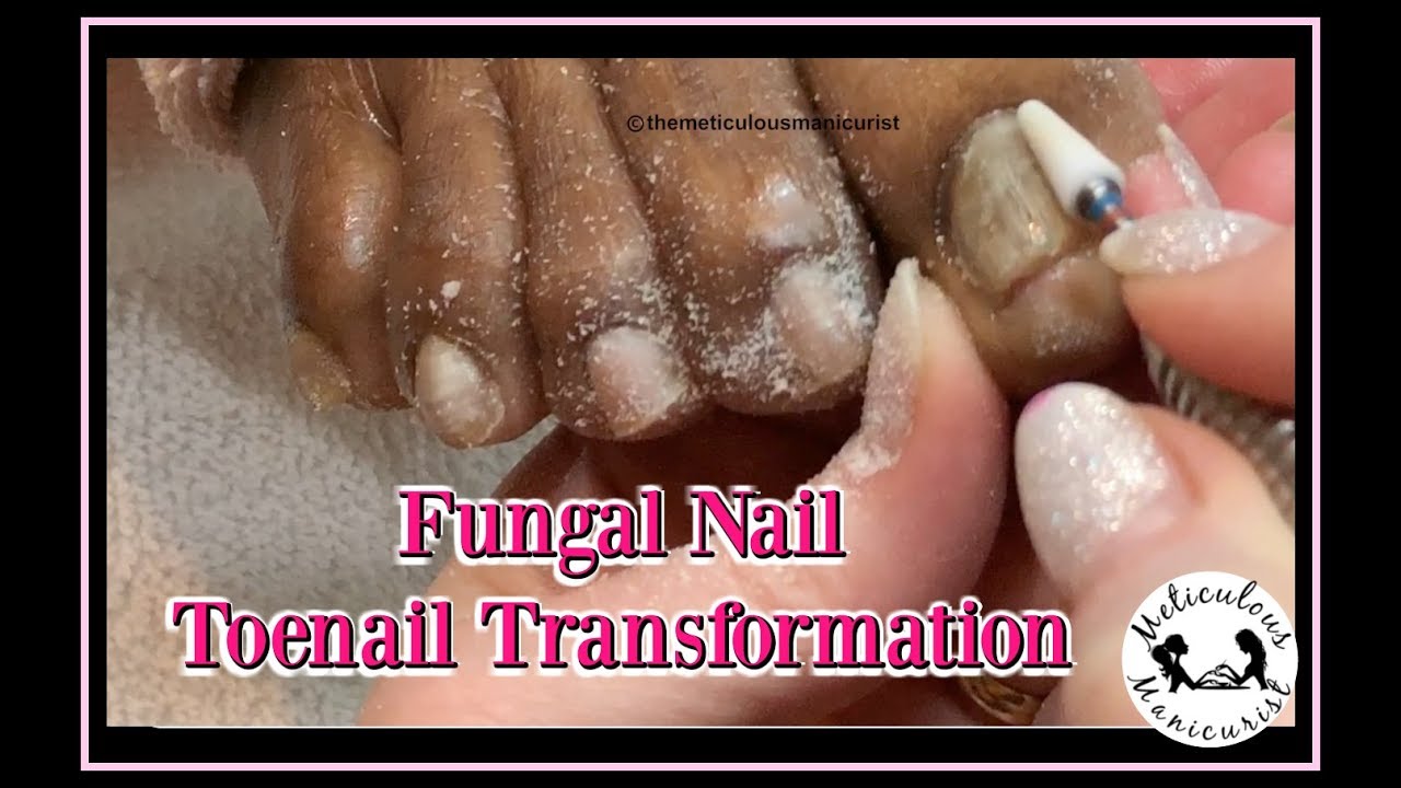 Pedicure Tutorial: Thick Fungal Toenail Transformation