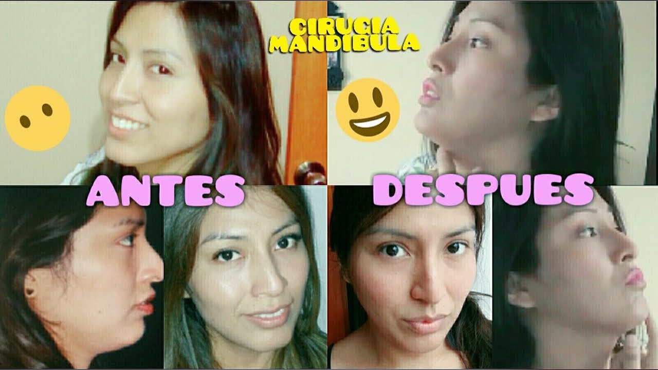 Pros y Contras de la Cirugía de Afinamiento de Mandibula (Parte 2) Feminizacion 3 Meses Despues