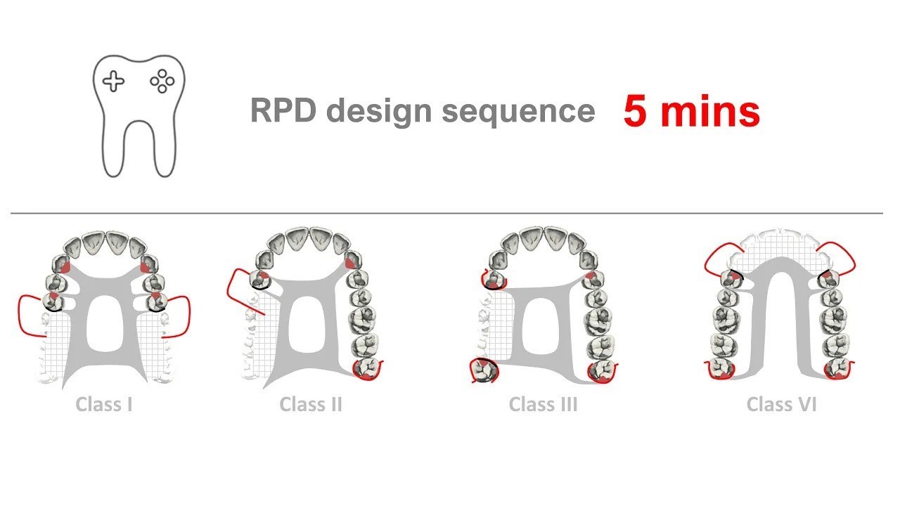 RPD design in 5 mins