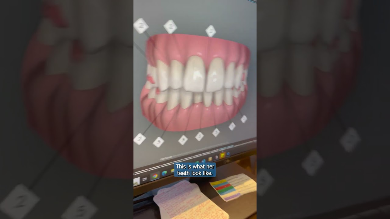 Part 1: Invisalign Clincheck