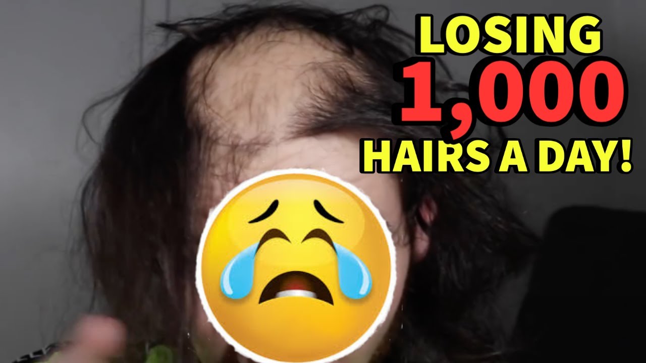 LOSING 1,000 HAIRS A DAY AFTER TAKING FINASTERIDE! HERE'S WHY.