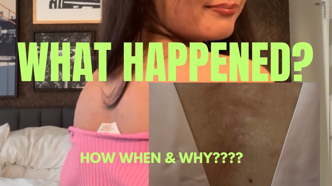 My biggest insecurity&hellip; finally sharing it!!!               #explore #acne #skin #fypシ 