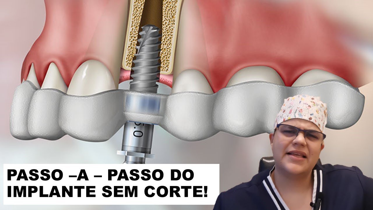 Passo-a-passo da técnica do implante sem corte | Master Pride Odontologia | Dra Bianca Rosa