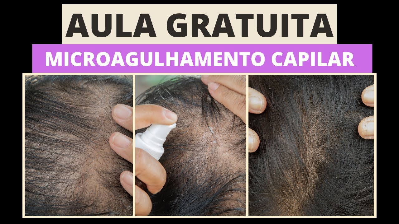 AULA PRÁTICA GRATUITA -  MICROAGULHAMENTO CAPILAR COMO APLICAR DA FORMA CERTA