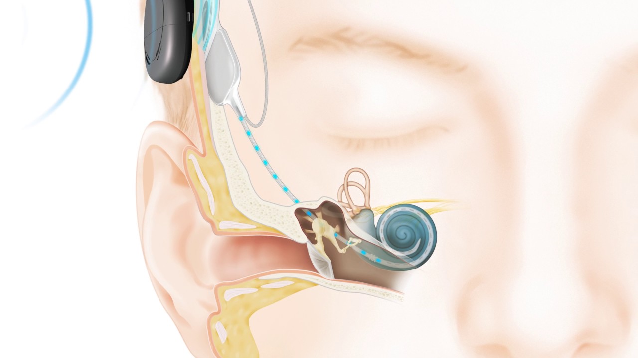 How Cochlear™ hearing solutions work: Nucleus® Kanso™ Sound Processor
