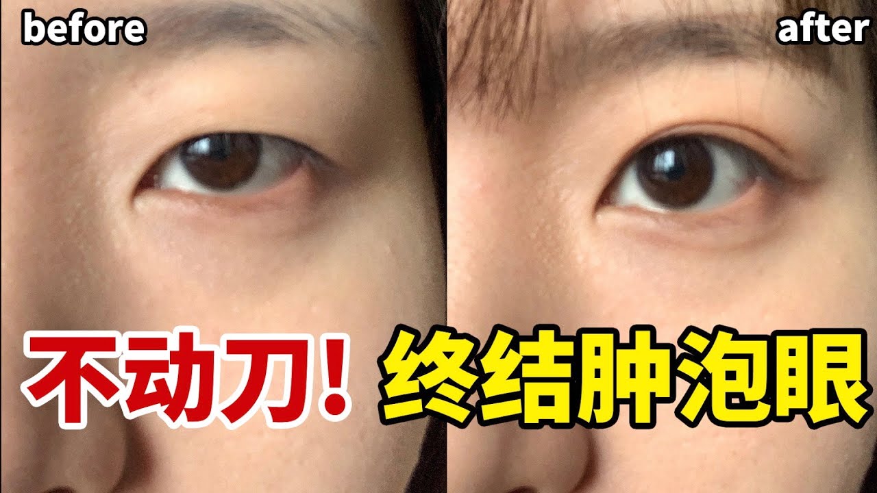 3分鐘消除眼皮肥厚| 眼皮浮腫 日本雙眼皮操get深邃大眼