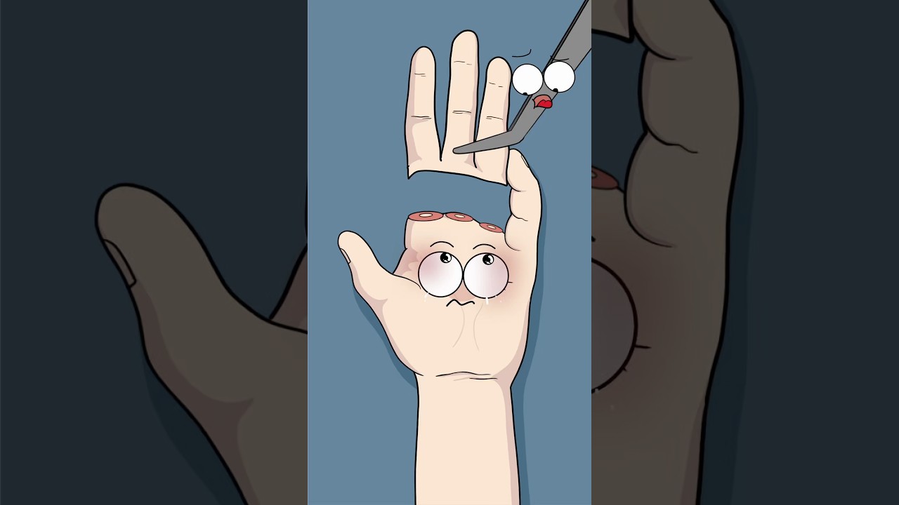 This Is How They 3D Printed His Fingers