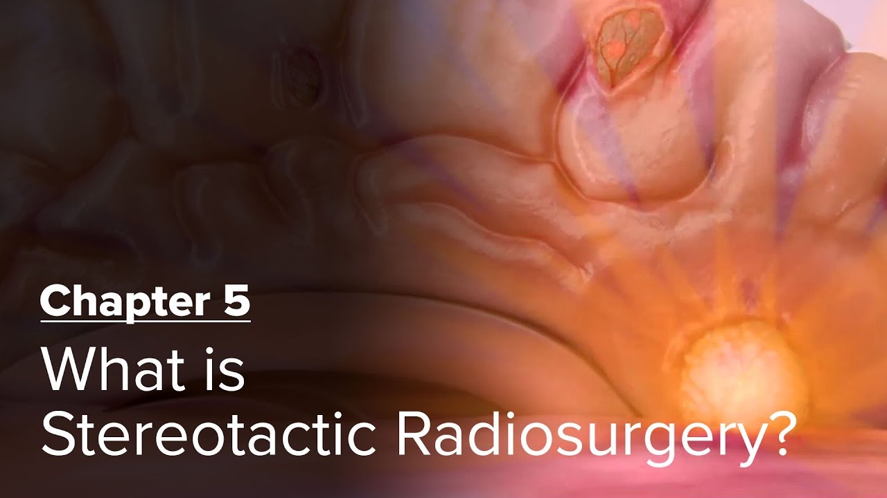 What is Stereotactic Radiosurgery? Chapter 5 &mdash; Brain Metastases: A Documentary