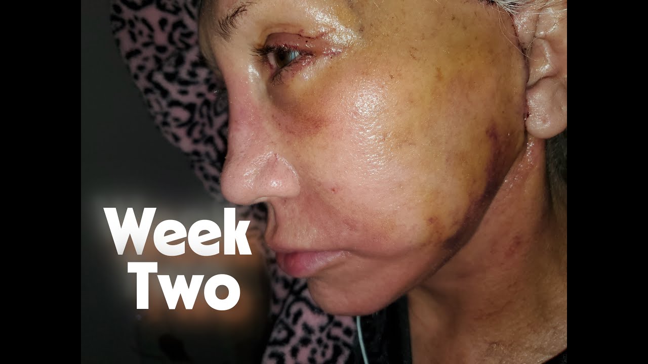 Week 2 Facelift + Recovery | Severe Bruising, Stitches, & Swelling