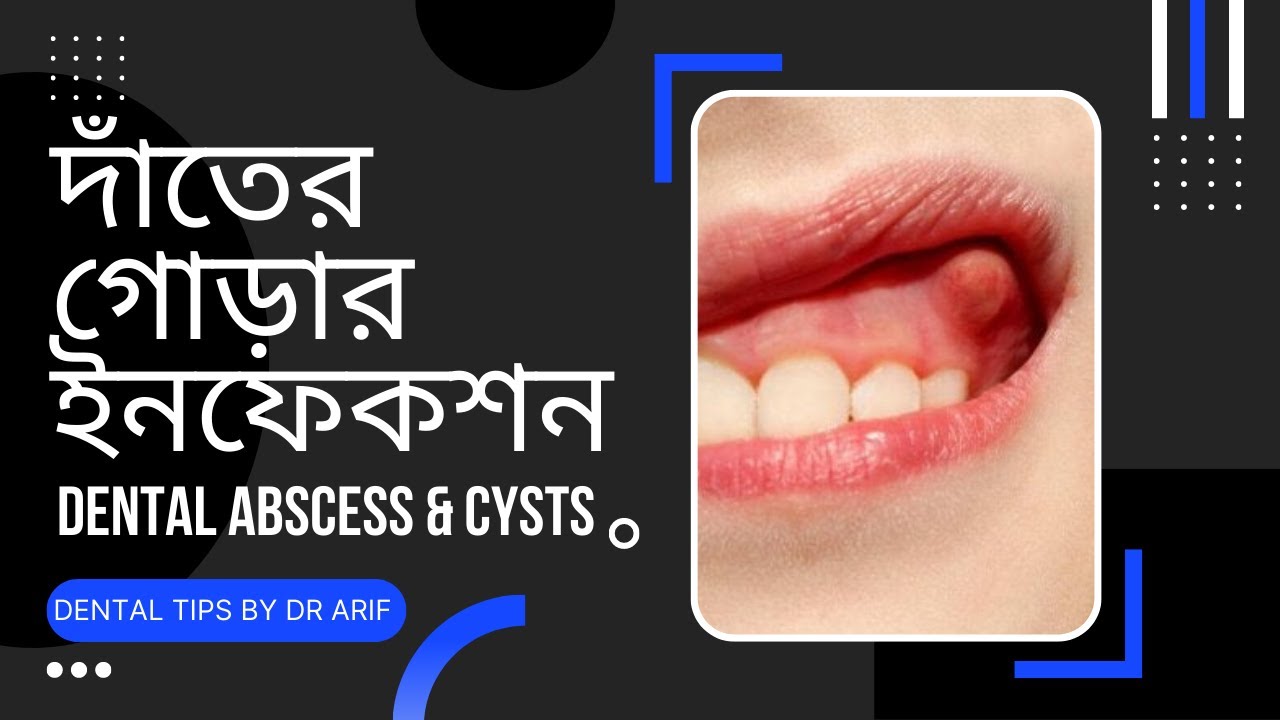 দাঁতের গোড়ার ইনফেকশন | Dental Abscess