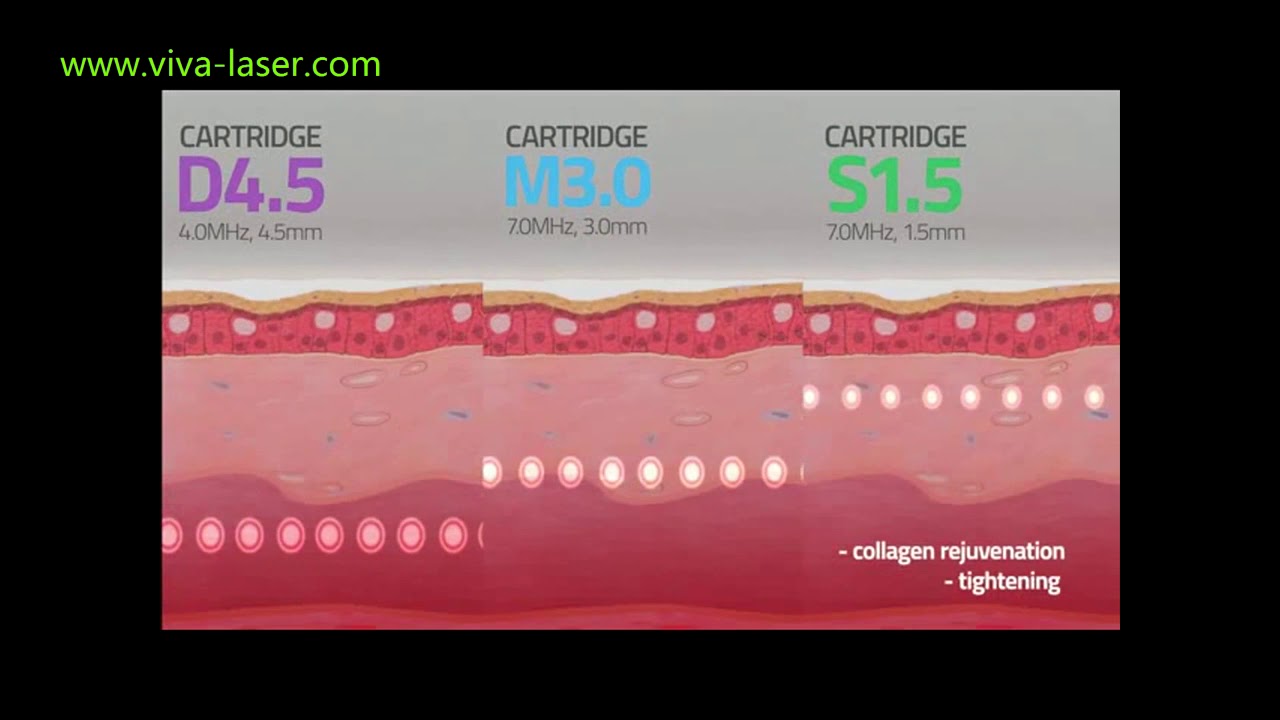 HIFU vaginal tightening