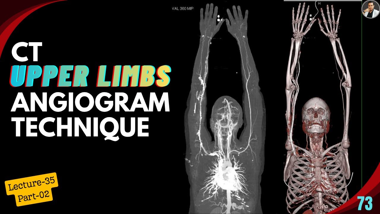CT Upper limbs Angiogram Technique - Part : 02 | Protocols | Post-processing | Abnormal Cases |