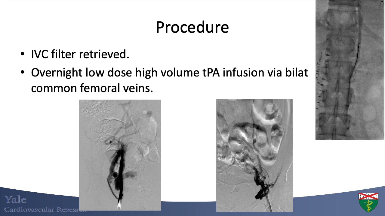 CVI 2020 Vein Case - One of my most memorable vein cases. Why venous return matters.