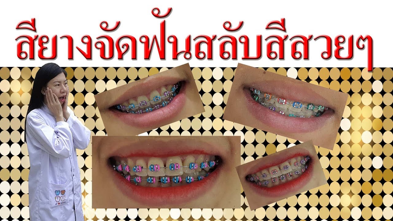 สียางจัดฟันสลับสีสวยๆ