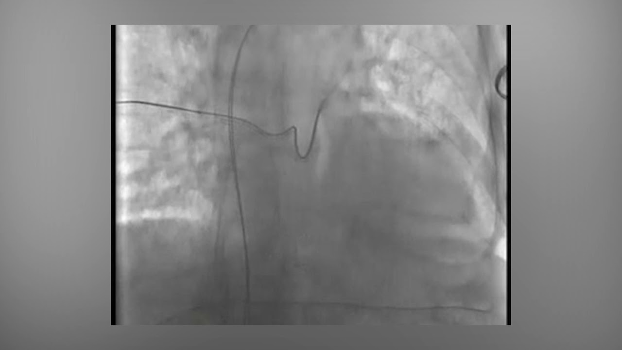 Fluoroscopic loop demonstrates axillary access