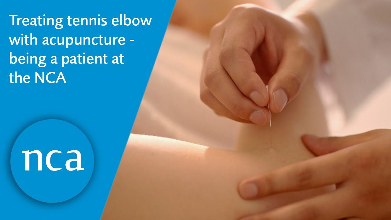 Year 3 acupuncture student Sam talks about treating Marketing Manager Denise's tennis elbow | NCA