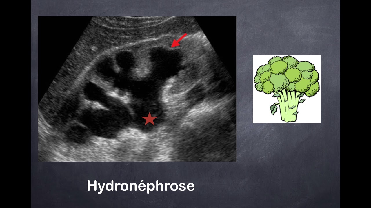 Infections urinaires - 2. Pyélonéphrite aiguë - échographie