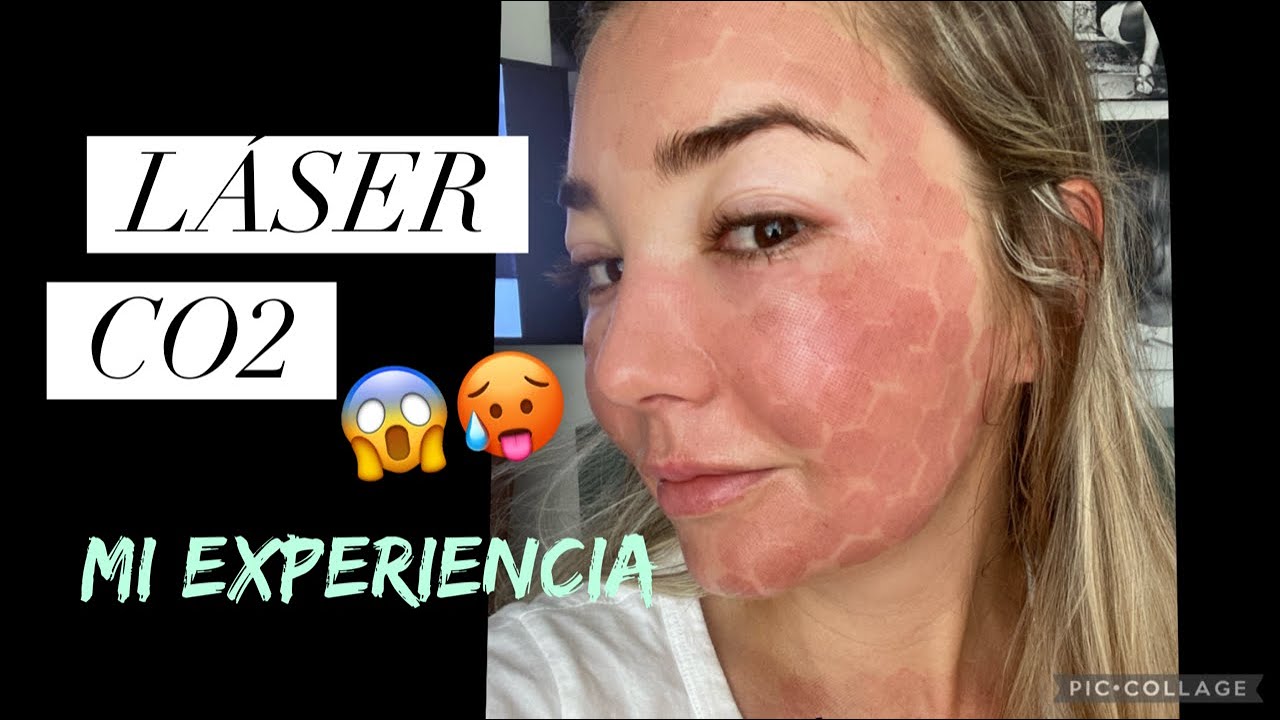 TODO SOBRE EL LASER FRACCIONADO | PIEL DE BEBE  | ALEJA FRANCO