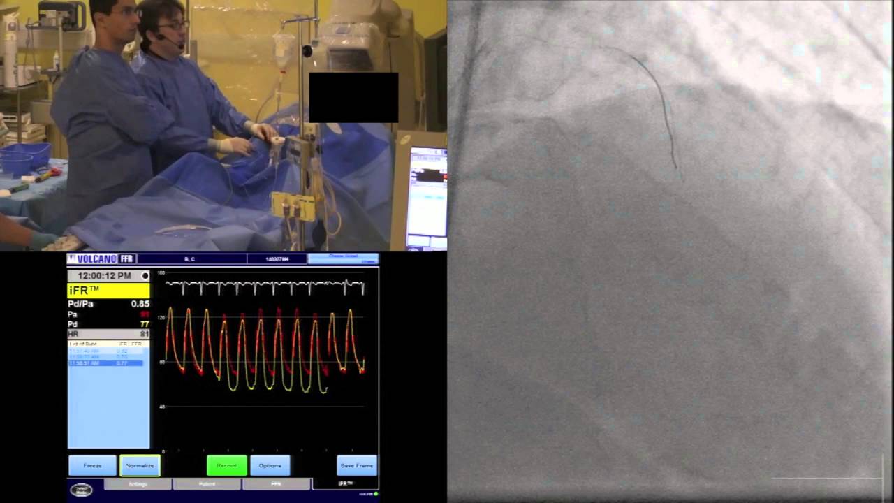 iFR Modality with Verrata in Multi Vessel Disease