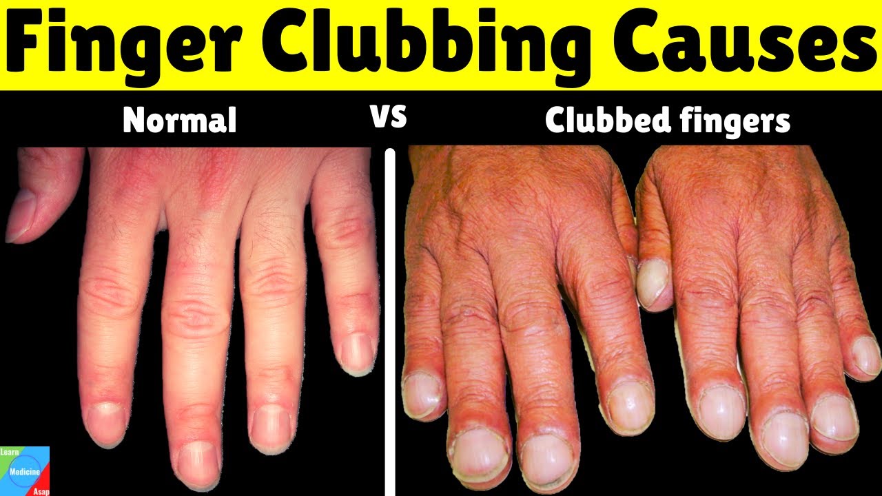 Finger Clubbing | Finger (Nail) Clubbing Causes | Grades of Finger Clubbing