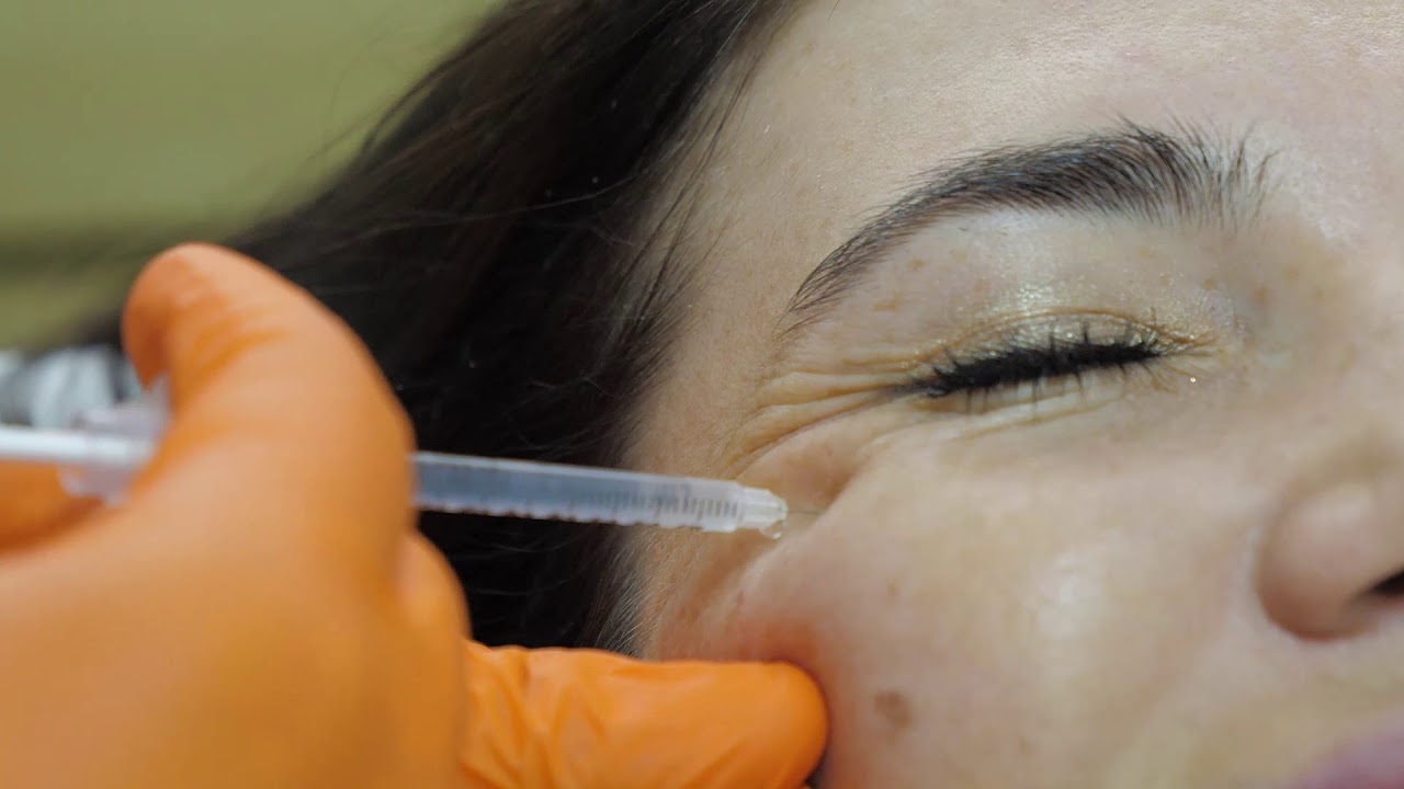 Dr. PASCAL DAMEH, injectare Botox unei paciente cu varsta de sub 30 de ani. Explicatii, proceduri.