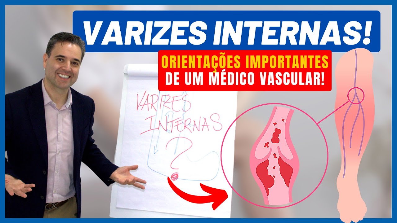 Varizes Internas - Existem Varizes que ficam 