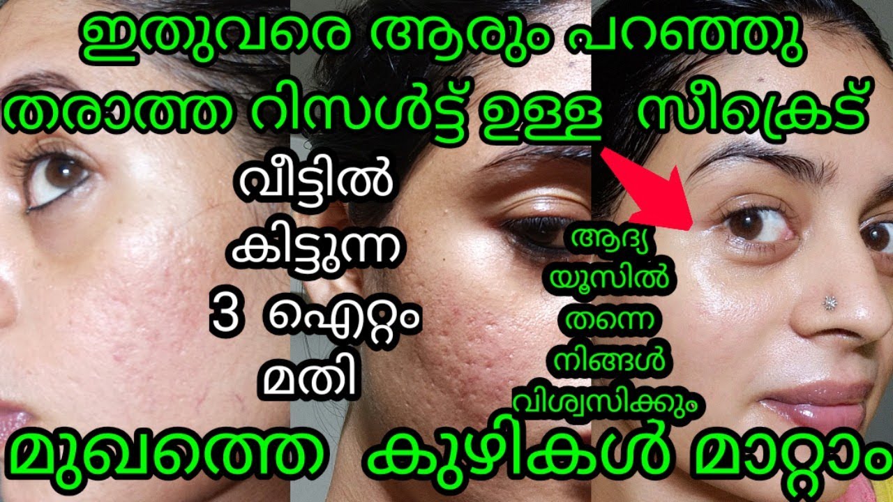 How To Reduce Open Pores || Naturally at Home ||Get Instant Glow to Face ||Nila lifestyles malayalam