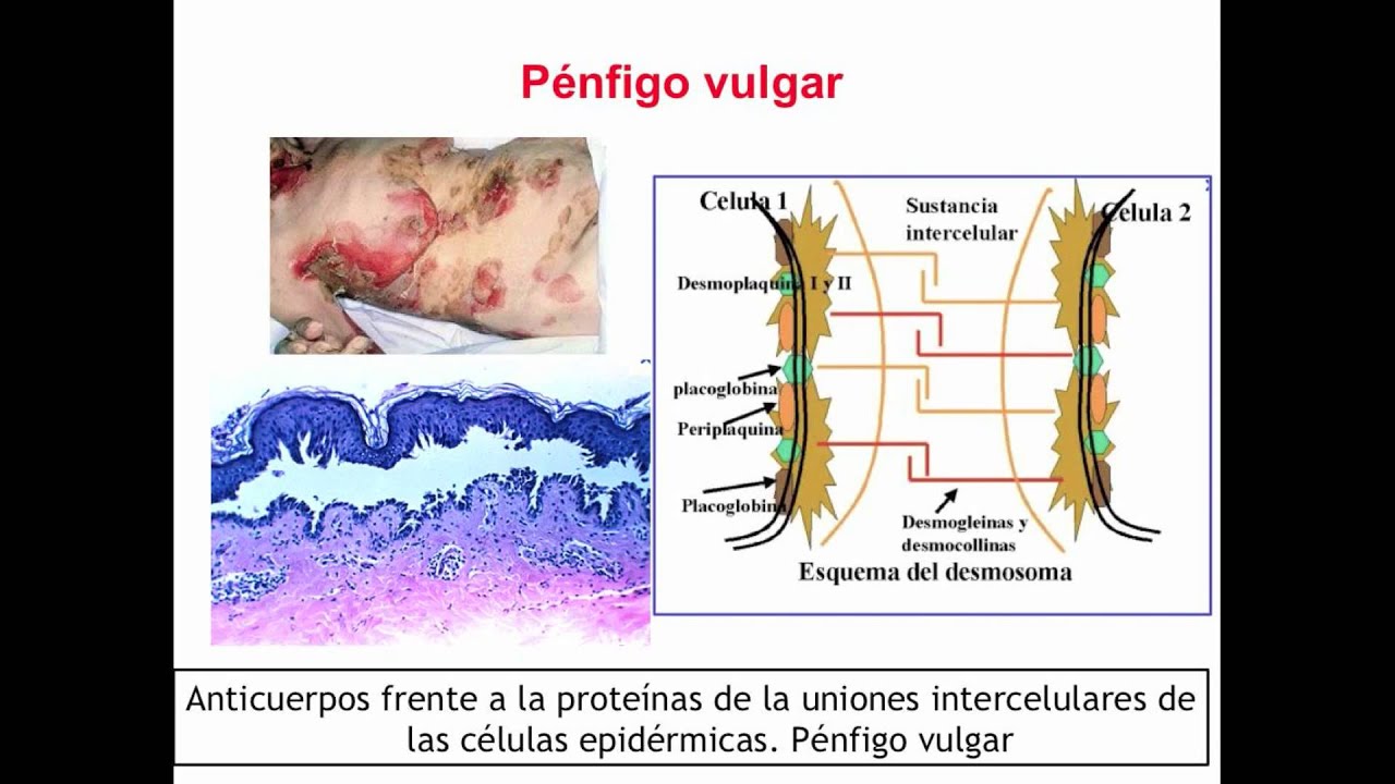 umh1947 2012-13 Lec001 Otras enfermedades de base autoinmune (II)