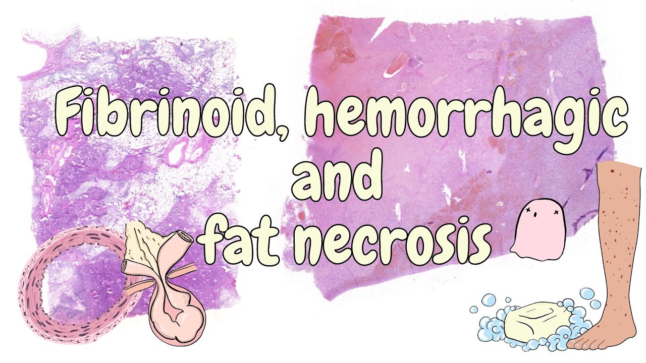 Fibrinoid, hemorrhagic and fat necrosis - general pathology