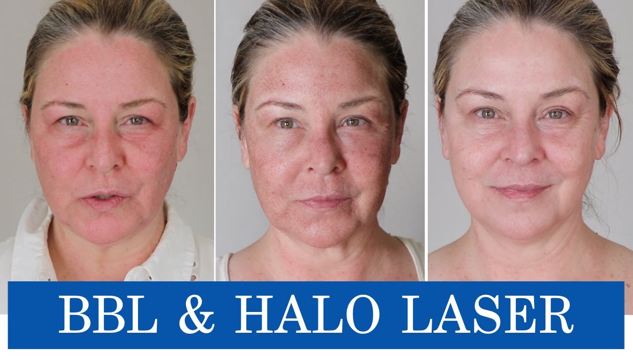 My Experience with BBL & HALO LASER - Six Day Recovery Log