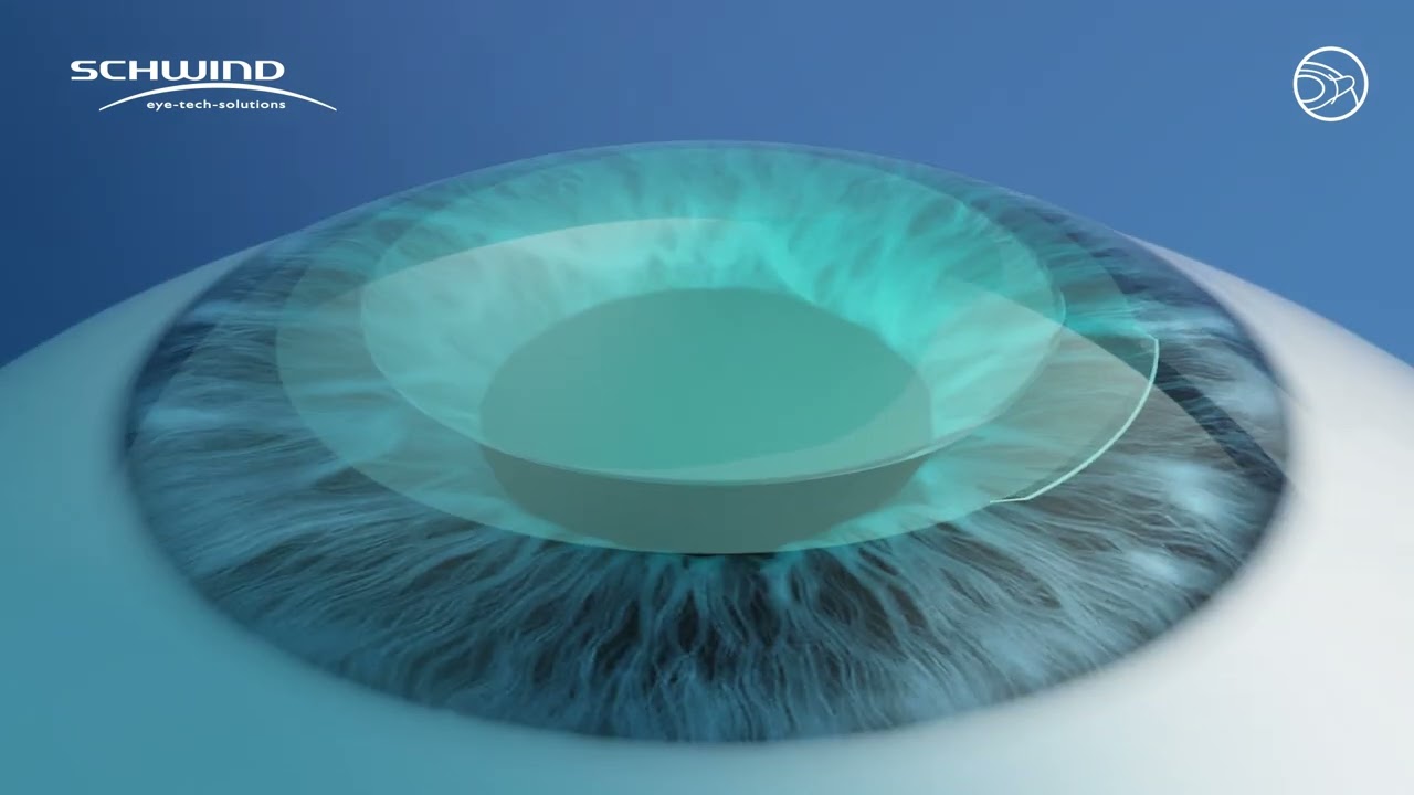 Advanced Femtosecond Laser Lenticular Extraction (LEX) at Centre for Sight