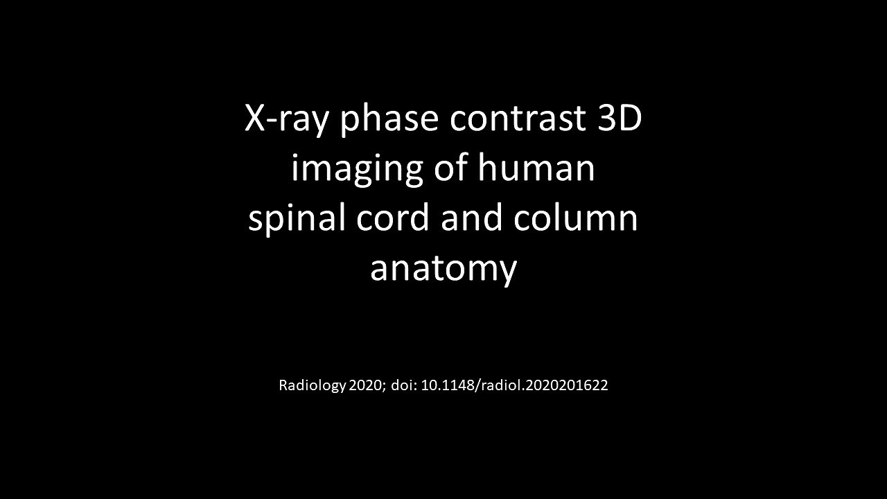 X-ray phase contrast 3D imaging of human spinal cord and column anatomy