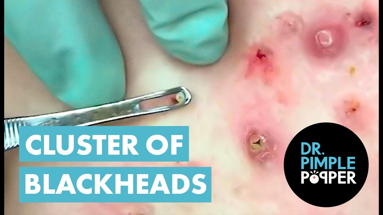 50 Minutes of Blackheads! Clusters of Blackheads with Dr. Pimple Popper