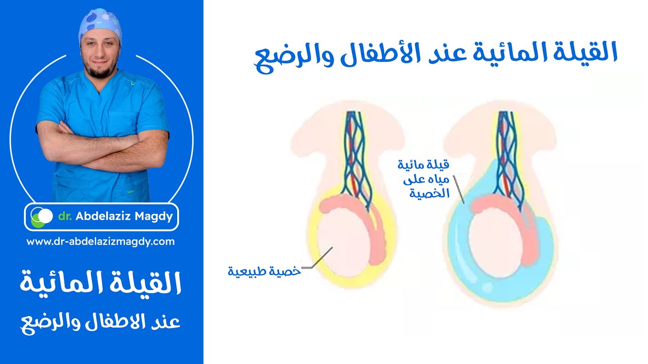 #القيلة_المائية - القيله المائيه عند الاطفال والرضع - المياه علي الخصية - الدكتور عبدالعزيز مجدي .