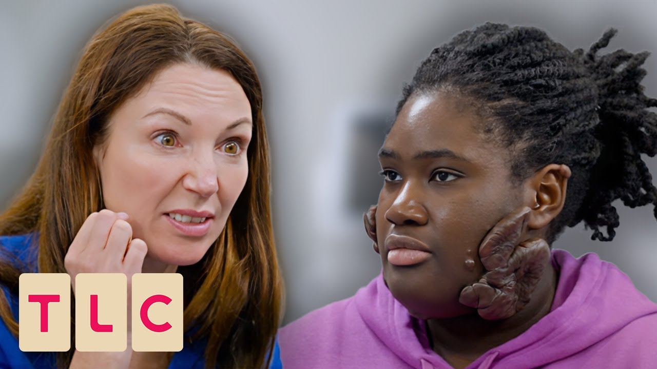 Dr. Emma Treats Patient With MASSIVE Keloids On Her Face! | The Bad Skin Clinic