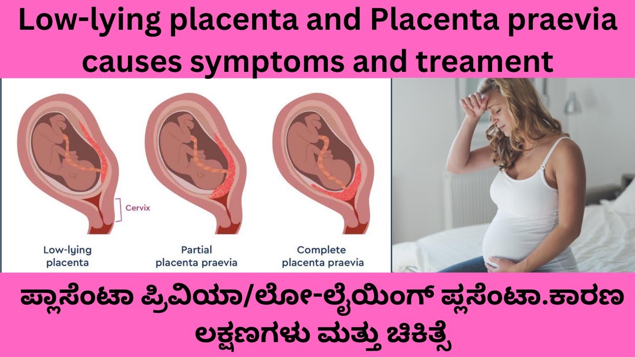 BLEEDING IN PREGNANCY.LOW LYING PLACENTA AND PLACENTA PREVIA CAUSES SYMPTOMS  TREATMENT  IN KANNADA