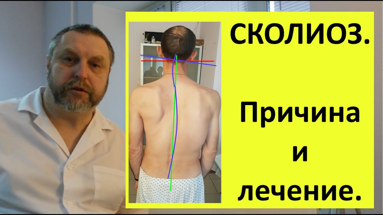 Лечение сколиоза. Самый лучший способ. И самый быстрый.