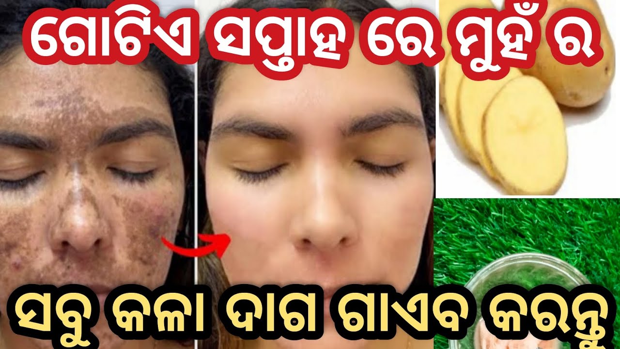 ମାତ୍ର ୭ ଦିନ ରେ /😄🙄 ମୁହଁ ର ସବୁ କଳାଦାଗ, କଳାଛଉ ଗାଏବ କରନ୍ତୁ ll How to cure malesma at home
