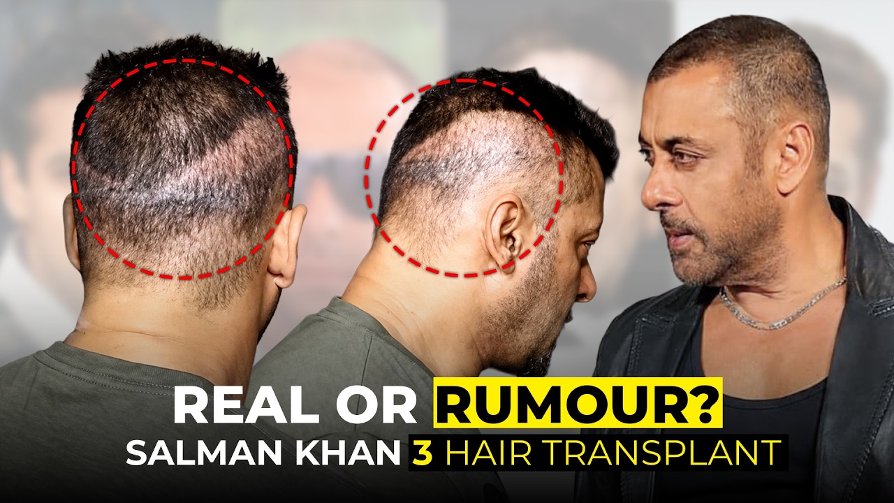 Salman Khan Hair Transplant Journey (HX-YNBD) | What Really Happened?