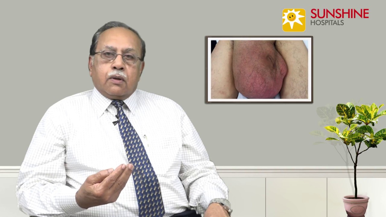 Watch Dr. C. S. Indra Mohan, Consultant General Surgeon, talk about Hernia
