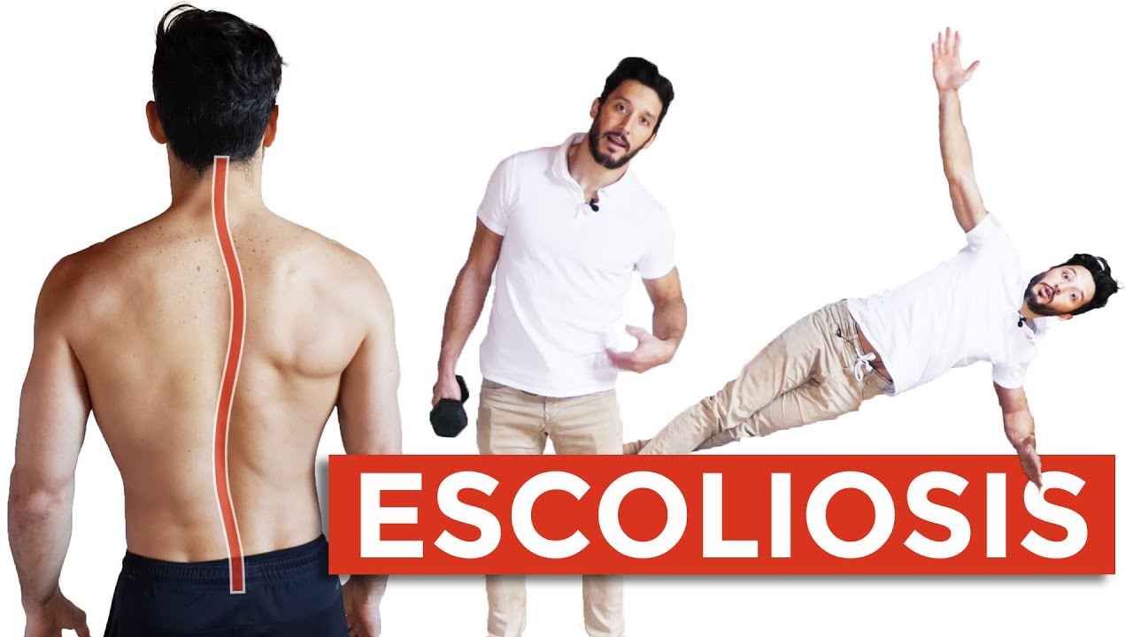 5 Ejercicios para la ESCOLIOSIS ¿Cuando Es Grave y Qué Hacer?