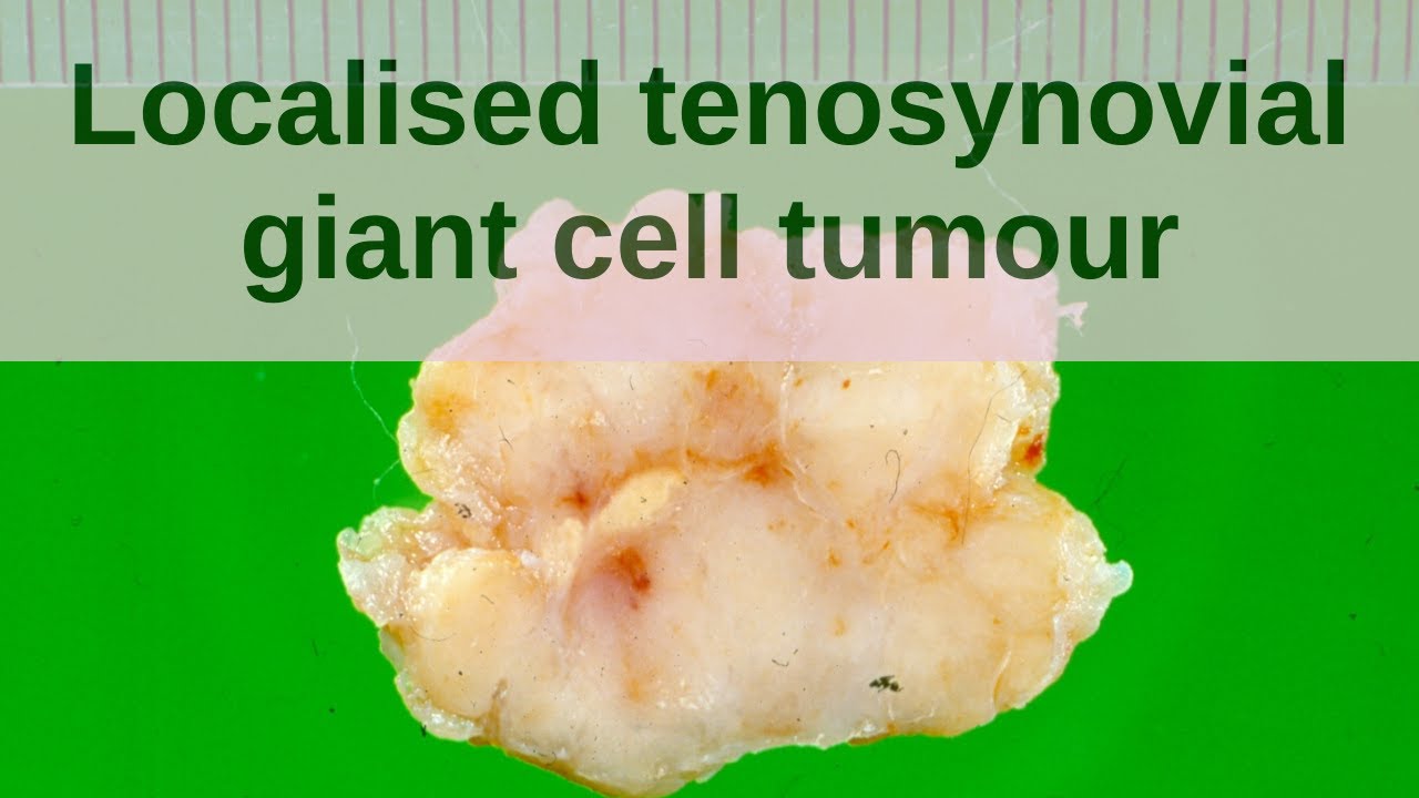 Localised Tenosynovial Giant Cell Tumour - Pathology mini tutorial