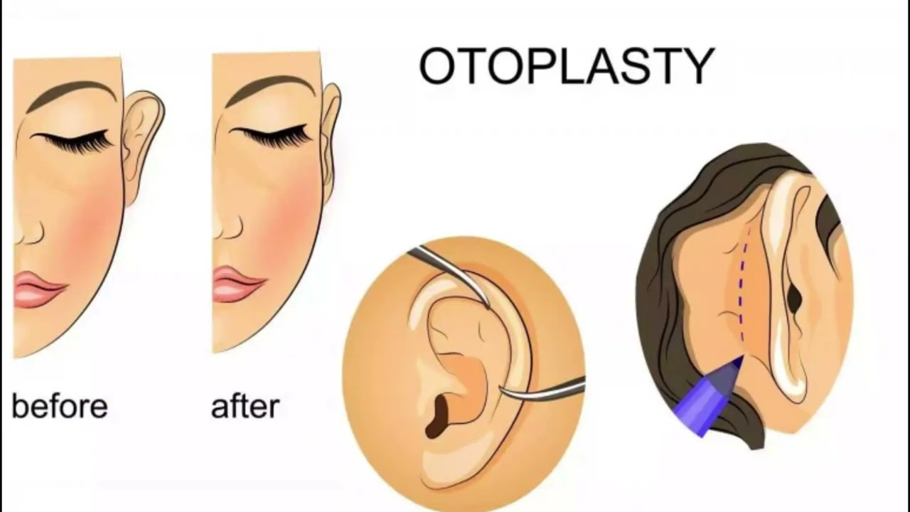 ОТОПЛАСТИКА 👩‍🔬💉 закреплённые назад, симметричные, красивые ушки