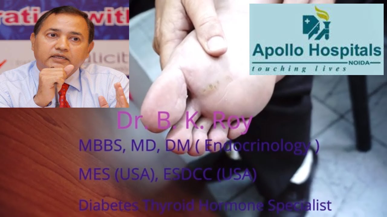 Callus Removal in Diabetes | callus removal from feet | callus remover gel |callus removal from feet